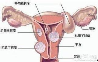 子宫肌瘤可以吃黑瓜,子宫肌瘤患者健康饮食指南